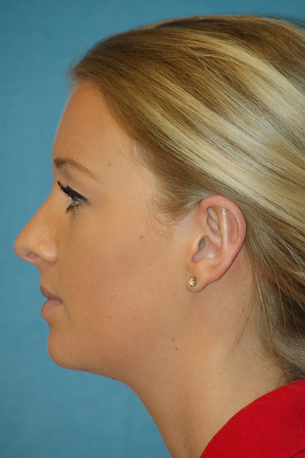 Otoplasty Southeast Texas Ear Nose Throat LLP